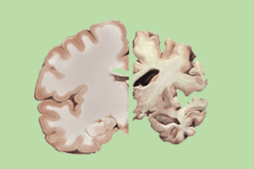 ¿Qué es el Alzheimer? Una batalla contra el olvido
